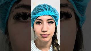 A Nose That Fits YOU Perfectly🤩Rhinoplasty👃 at Vive Plastic Surgery #tijuana 💖