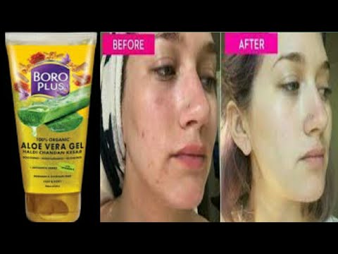 boroplus aloe vera gel for pimples