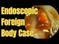 Endoscopic Foreign Body Case !!