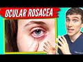 Ocular Rosacea Treatment - 7 Tips to Help get Relief!