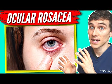 Video: Oculaire rosacea behandelen: 14 stappen (met afbeeldingen)