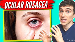 Ocular Rosacea Treatment - 7 Tips to Help get Relief!