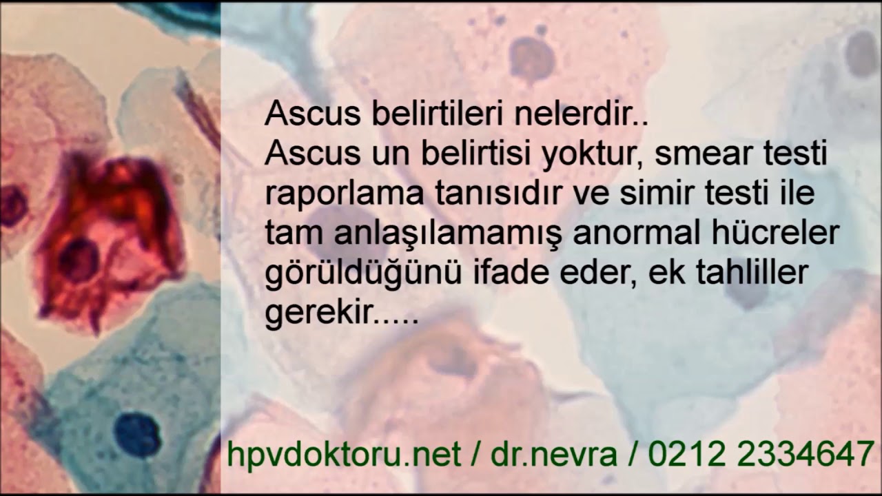 ASCUS nedir, ASCUS Tanı ve Tedavisi, ASCUS HPV 16 18, ASCUS  Kolposkopi Sonuçları