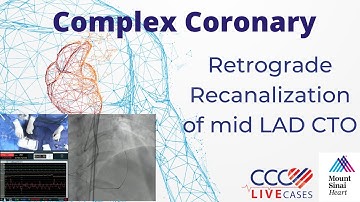 Retrograde Recanalization of mid LAD CTO - March 2022