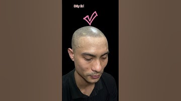 Quá buồn vì hói rụng chữa mãi khỏi... #xămtóc #scalp #reviewxămtóc