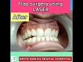 BLEEDING GUMS. Permanent cure with BIO LASE LASER dentistry.