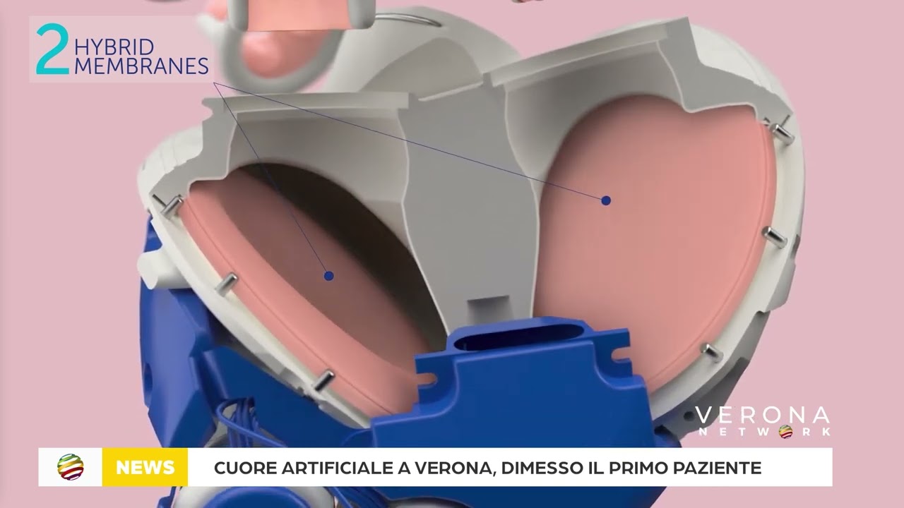 Cuore artificiale a Verona, dimesso il primo paziente
