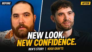 Ben Wore a Hat for 10 Years. Then He Got a 4,000-Graft Hair Transplant.