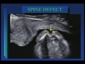 CNS Anomalies and Later Pregnancy