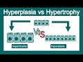 Hyperplasia vs Hypertrophy | Pathology | USMLE