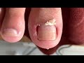 Clean the skin and remove the corner of the nail489