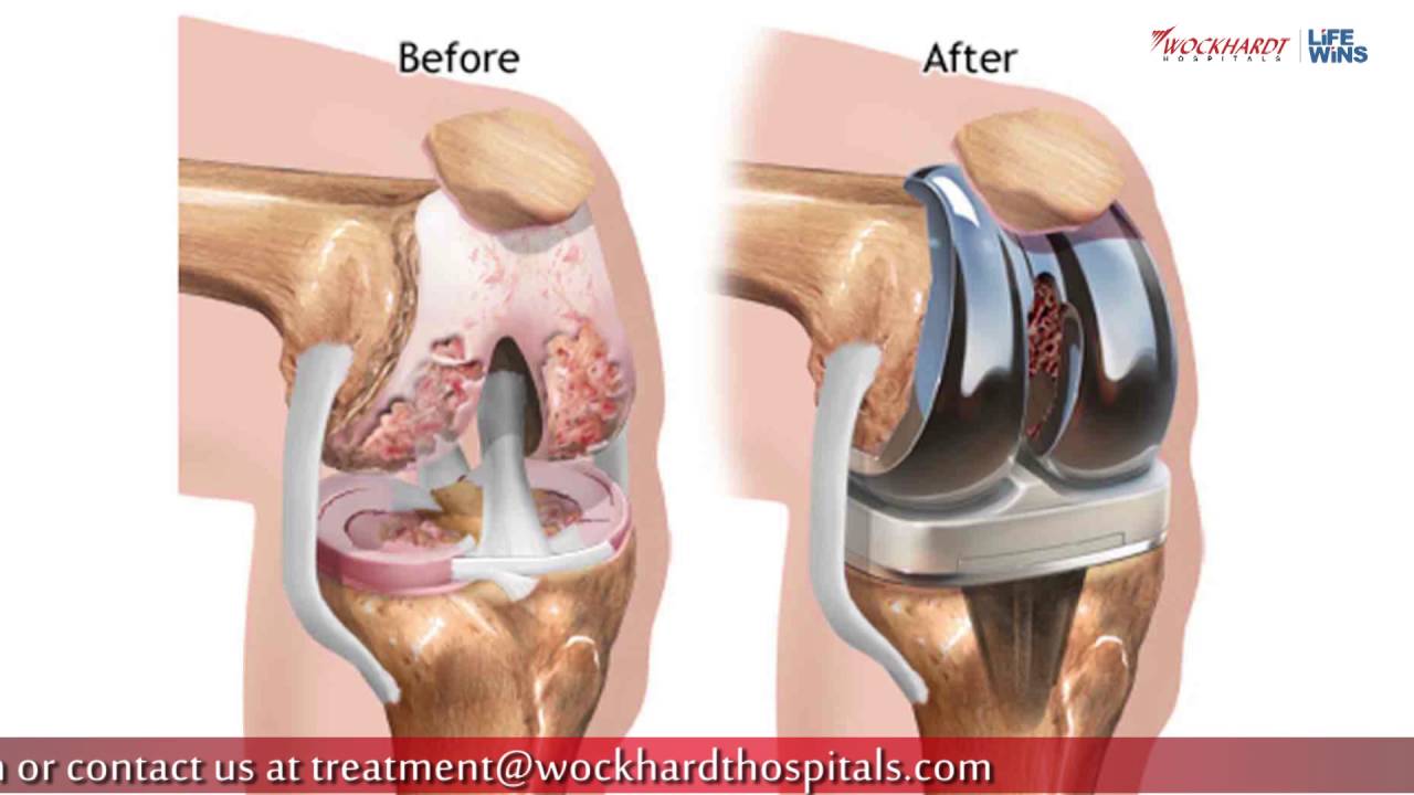 Osteoarthritis: causes, symptoms and features of treatment Osteoarthritis: causes, symptoms and features of treatment