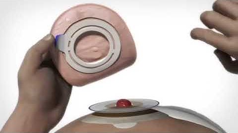 Applying a 2-piece SenSura Flex closed ostomy pouch