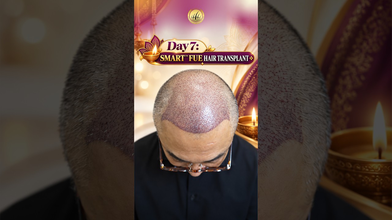 Hair Transplant Malaysia | Pakar Tanam Rambut | Day 7 Hair Transplant #hairtransplantmalaysia