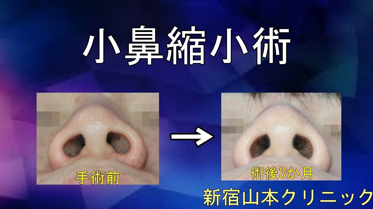 小鼻縮小 内側切開 山本クリニック Youtube 小鼻縮小 内側切開 山本クリニック Youtube