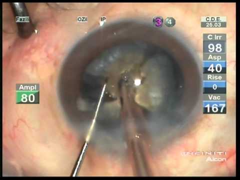 phacoemulsification
