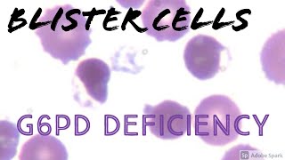 Blister cells (in Glucose-6-phosphate dehydrogenase G6PD deficiency): Peripheral Blood Smears screenshot 1