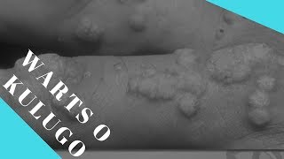 Warts Cauterization Step-By-Step