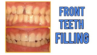 Front Teeth Filling #11,12,21,22 ( TEETH SMILE RESTORATION )