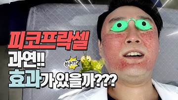 피코프락셀. 여드름 흉터에 과연 효과가 있을까?? (여드름흉터 치료 5탄!!)