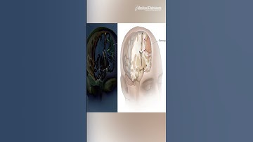 Is Air Pollution Quietly Increasing Brain Tumour Risk