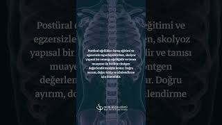 Postür Bozukluğu Her Zaman Skolyoz Anlamına Gelir Mi?