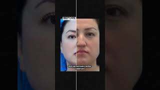 Why chin lipo makes nose jobs look better