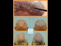 Dallas Hair Transplant Plug & Slot Deformity Correction with Beard FUE