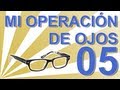 OPERACIÓN DEL SEGUNDO OJO | Experiencia personal operación ojos (lentes intraoculares) C-05