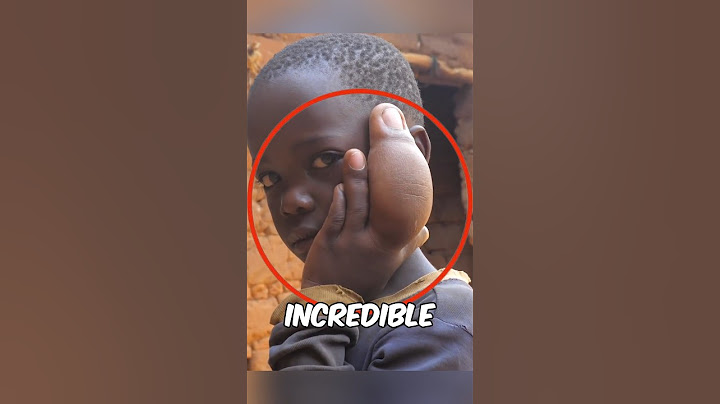 This Boy's Finger Won't Stop Growing😰😲