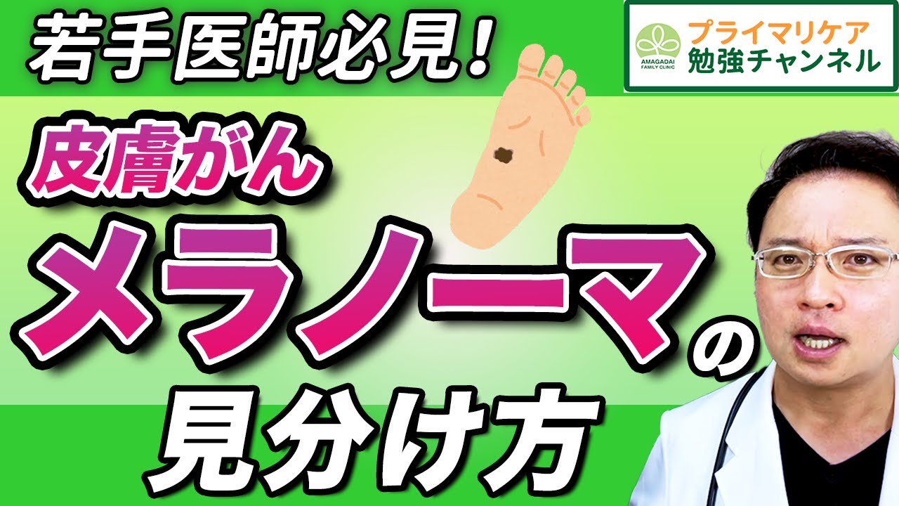 【皮膚がん 見た目からの初期症状の見分け方】ほくろとの見分け方【 詳しく解説! 若手医師必見】 - YouTube