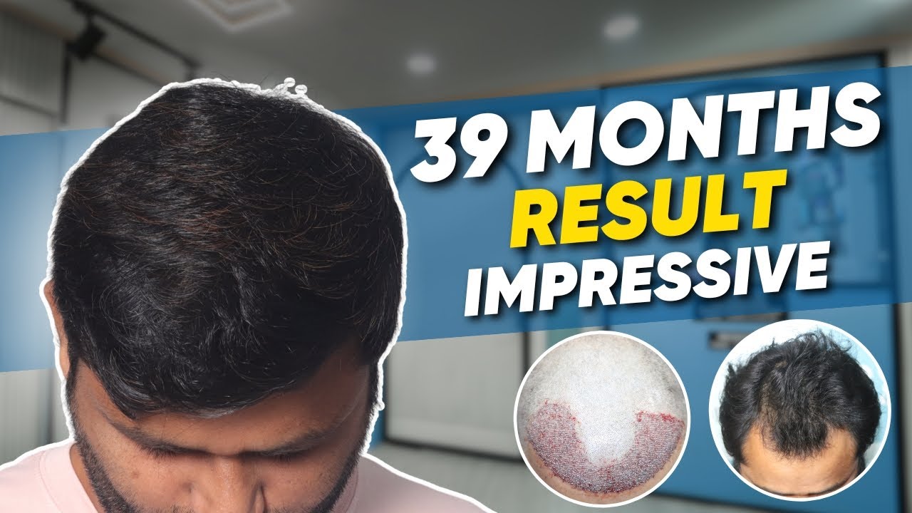 Hair Transplant in Chennai Best Results & Cost of Hair Transplant in