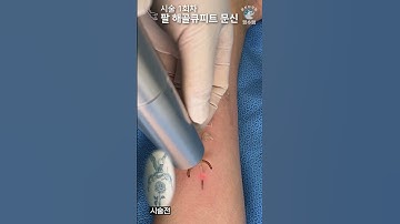 팔 해골큐피트 문신(타투)제거 ASMR - ALL 수면마취 [Laser Tattoo Removal]