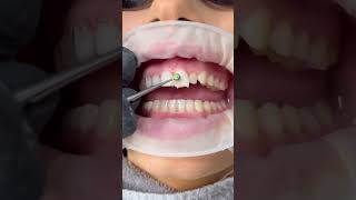 Dr. Sonnie composite bonding in action. 😮😍 #cosmeticdentistry #invisalign