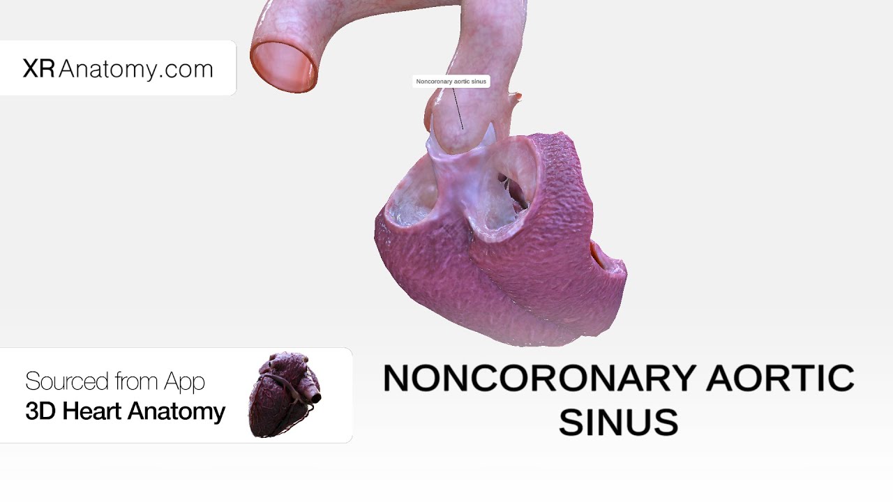 Noncoronary aortic sinus
