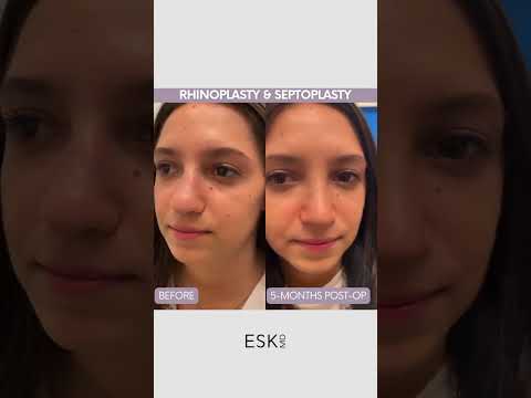 Video thumbnail: Rhinoplasty | Septoplasty | Plastic Surgery Before & After | Nose Augmentation