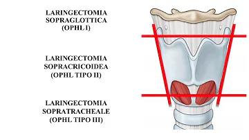 Come ti accorgi di avere un tumore alla gola?