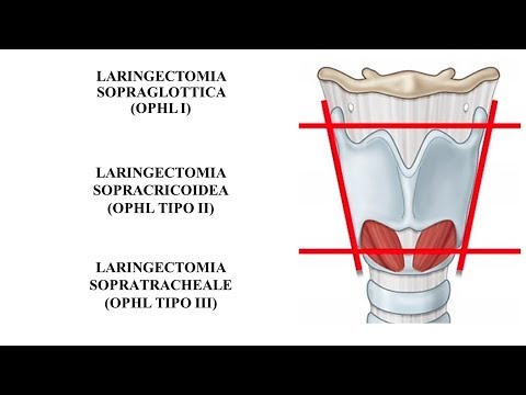 Video: Perché viene eseguita la laringectomia?