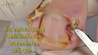 A PACIENTE JÁ NÃO AGUENTAVA MAIS, TADINHA | Granuloma de grau IV#satisfying #viral