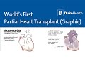 Animation graphic  worlds first partial heart transplant  duke health