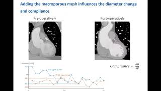 Biomechanical Evaluation Of Personalized External Aortic Root Support Pears Case-Study