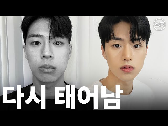 흔남에서 훈남으로 변신 | 성형비포애프터 | 에이비성형외과