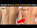 How To Get Rid of Back Acne &amp; Pimples in 3 Days | Naturally Get Smooth Back &amp; Clear Skin