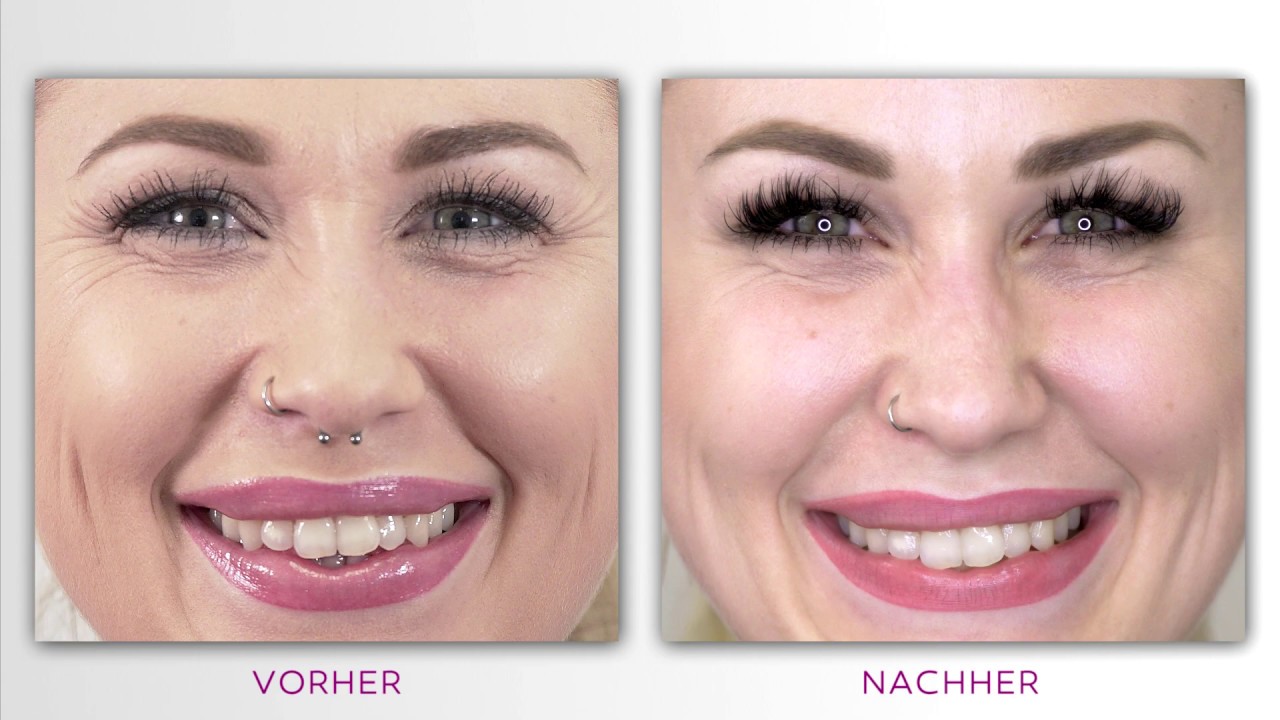 Dr Isabell Sick Nasenkorrektur Botox Skinbooster YouTube dr-isabell-sick-nasenkorrektur-botox-skinbooster-youtube