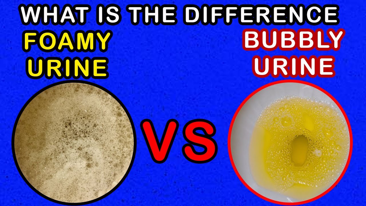 Differences Between Foamy Urine Vs Bubbly Urine Youtube 