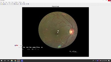 Detection of Diabetic Retinopathy in Matlab