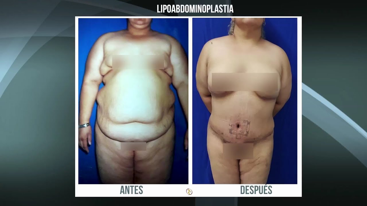 Quitar la del estrias abdomen como y flacidez