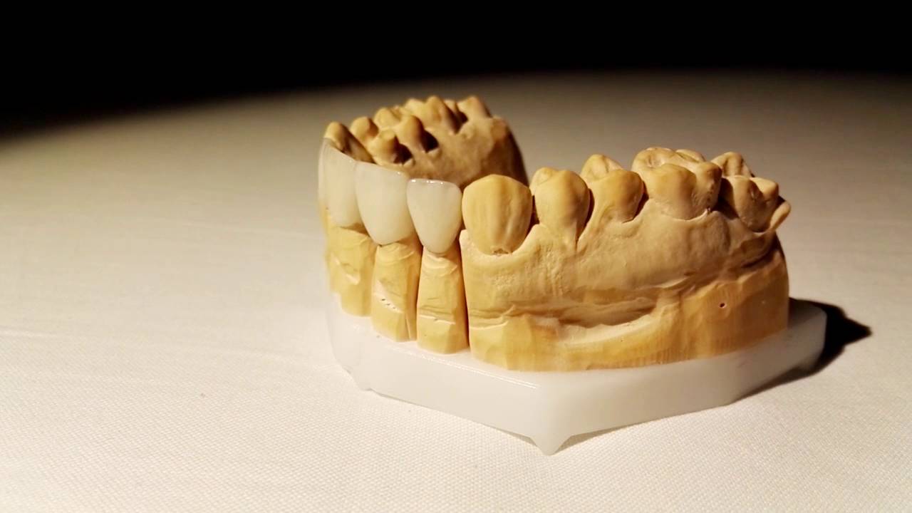 Ivoclar IPS e.max Crowns YouTube