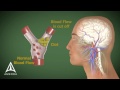 Stroke  3d medical animation