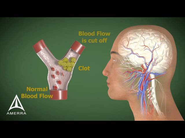 Stroke - 3D Medical Animation class=